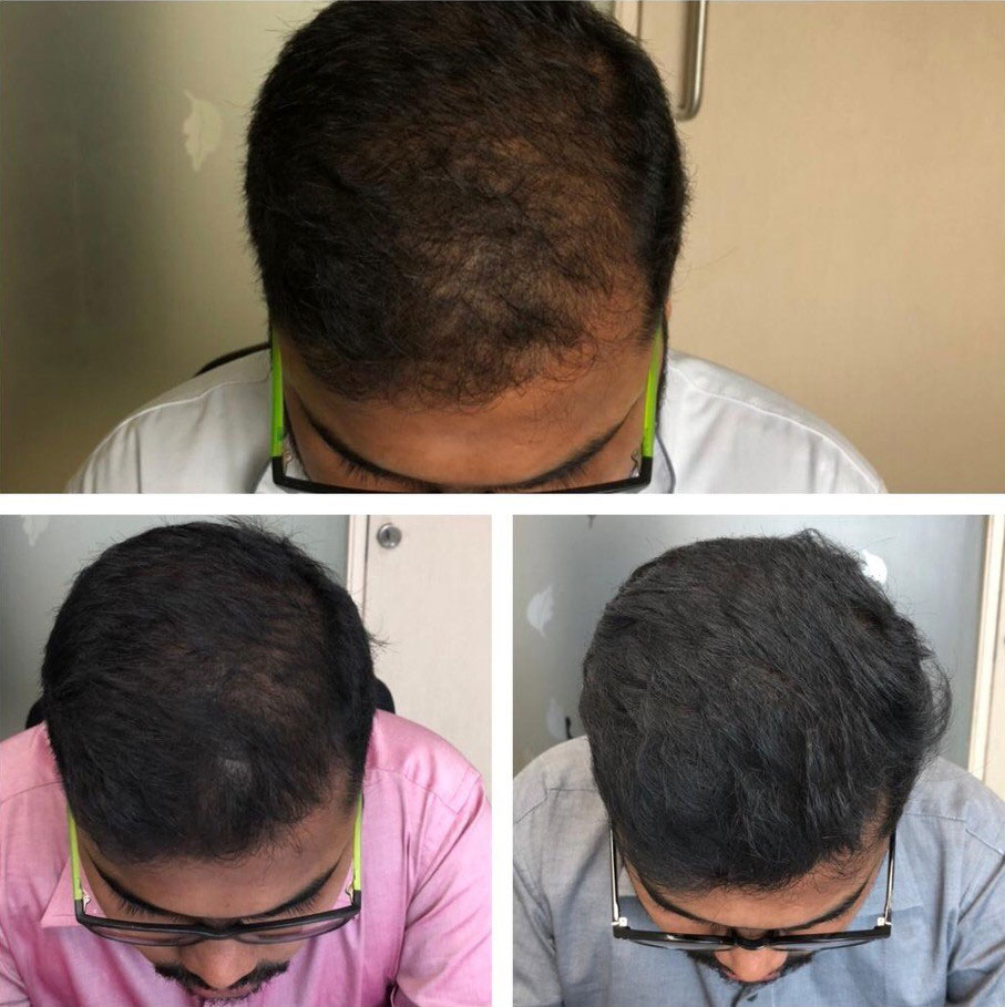 Hair Treatment Before After