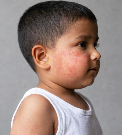 Pediatric Dermatology