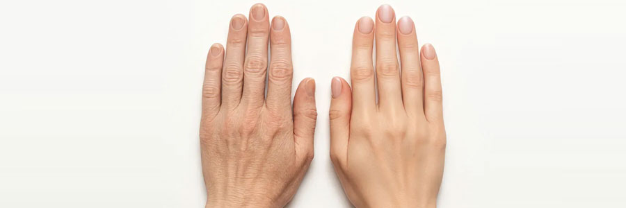 Hand Rejuvenation