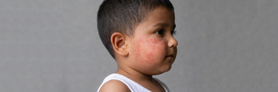 Pediatric Dermatology